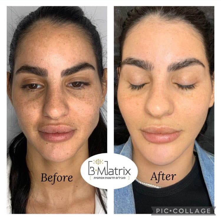 תוצאות טיפול B-Matrix 1