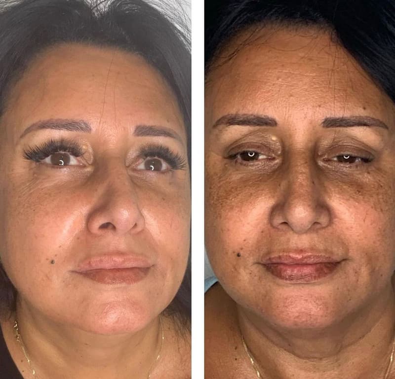 תוצאות טיפול B-Matrix 3